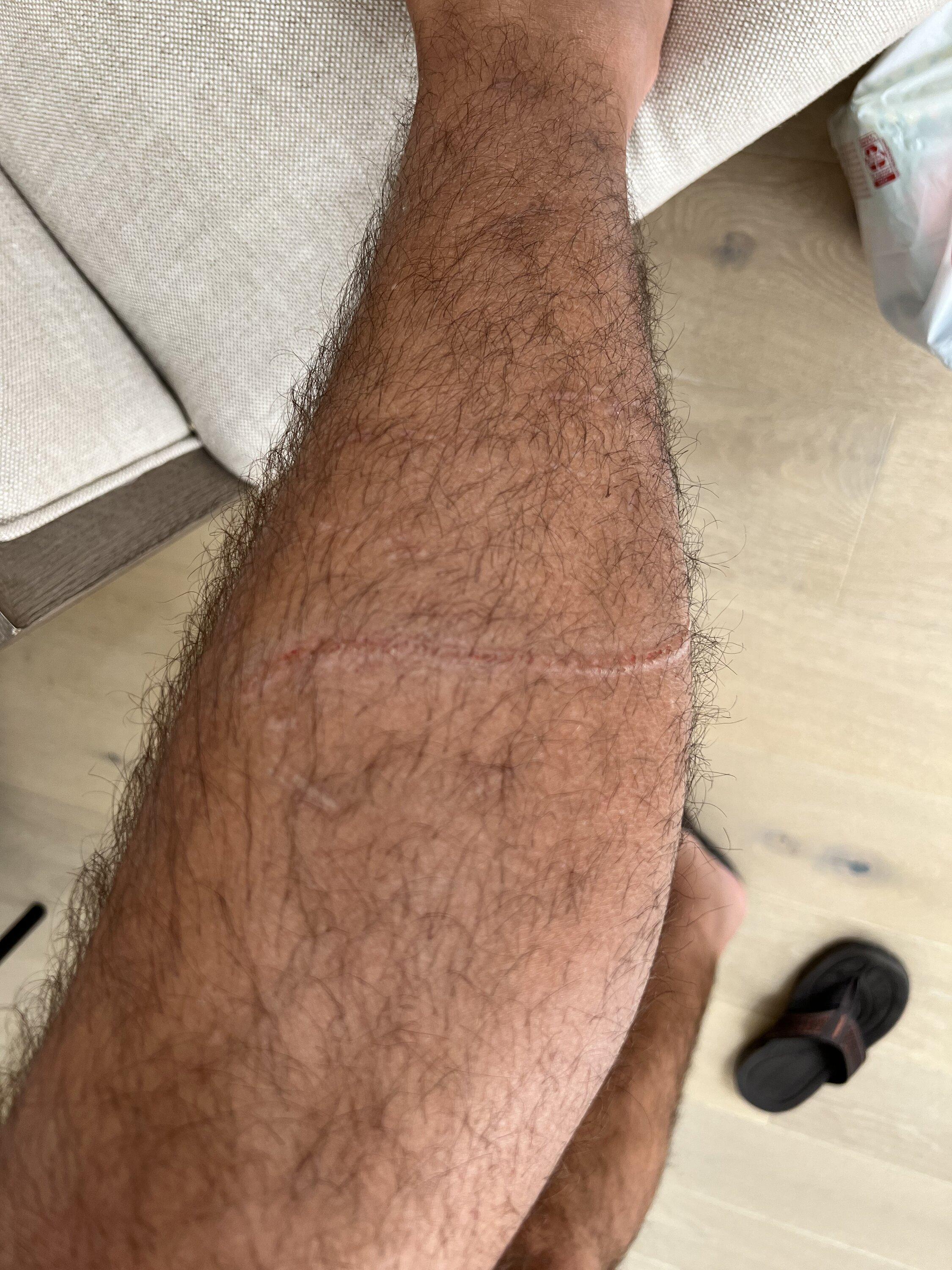 Rivian R1T R1S Anyone else get this scar on their leg? 080DCA4E-AE4F-409A-989A-7C11D70E61DA